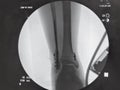 X-ray of metal implants through broken fibula Royalty Free Stock Photo