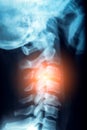 X-Ray or MRI of human neck with red zone of pain and stress in spine or vertebrae, trauma and rheumatism concept Royalty Free Stock Photo