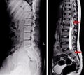 X-ray and MRI Lumbar spine Royalty Free Stock Photo