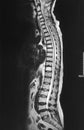 X-ray mri lumbosacral spine a case of low back pain