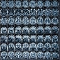 X-Ray or MRI scan or magnetic resonance tomography image of human brain and head, neurology concept Royalty Free Stock Photo