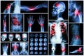 X-ray multiple disease (Stroke (cerebrovascular accident) : cva ,Pulmonary tuberculosis ,Bone fracture ,Shoulder dislocation