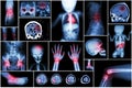 X-ray multiple part of child's body & multiple disease ( stroke , brain tumor , rheumatoid arthritis , sinusitis , gouty arthriti Royalty Free Stock Photo