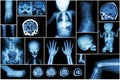 X-ray multiple part of child's body & multiple disease ( stroke , brain tumor , rheumatoid arthritis , sinusitis , gouty arthriti Royalty Free Stock Photo