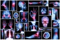 X-ray multiple part of human with multiple disease (stroke, arthritis, gout, rheumatoid, brain tumor, osteoarthritis, etc) Royalty Free Stock Photo