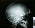 X-ray of my younger brother head Royalty Free Stock Photo