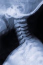 X-ray of neck and cervical spine.Roetgen of 3 month old baby .Side view. Old bluring image Royalty Free Stock Photo