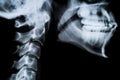 X ray neck and Jaw Royalty Free Stock Photo