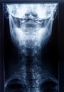 X-ray of the neck and skull - Rear view