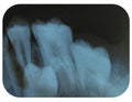 X-Ray Negative Tooth Impaction