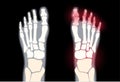 Arthritis foot concept