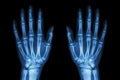 X-ray normal human hands (front) on black background Royalty Free Stock Photo