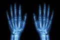 X-ray normal human hands (front) on black background Royalty Free Stock Photo