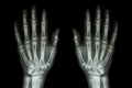 X-ray normal human hands (front) Royalty Free Stock Photo