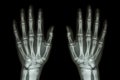 X-ray normal human hands (front) Royalty Free Stock Photo