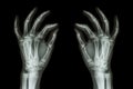 X-ray normal human hands (front) on black background
