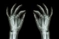 X-ray normal human hands (front) on black background Royalty Free Stock Photo