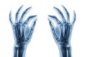 X-ray normal human hands on white background . Oblique view Royalty Free Stock Photo