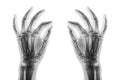 X-ray normal human hands on white background . Oblique view Royalty Free Stock Photo