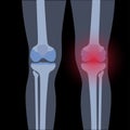 Arthritis in knee joint Royalty Free Stock Photo