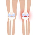 Arthritis in knee joint