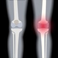 Arthritis in knee joint Royalty Free Stock Photo