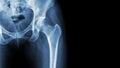 X-ray normal pelvis and hip joint . Blank area at right side Royalty Free Stock Photo