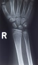 Wrist hand injury xray scan Royalty Free Stock Photo