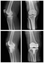 X-ray OA knee Royalty Free Stock Photo