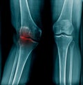 Genu valgus knee Royalty Free Stock Photo