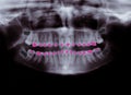 X-ray of orthodontic braces