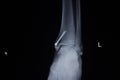 X-ray orthopedics scan of ankle foot injury implant