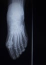 X-ray orthopedics scan of foot injury anterior posterior AP