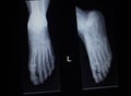 X-ray orthopedics scan of foot injury anterior posterior AP Royalty Free Stock Photo