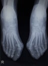 X-ray orthopedics scan of foot injury anterior posterior AP Royalty Free Stock Photo