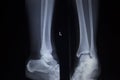 X-ray orthopedics scan of foot injury anterior posterior AP Royalty Free Stock Photo