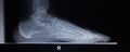 X-ray orthopedics scan of foot injury load weight bearing Royalty Free Stock Photo