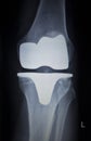 X-ray orthopedics scan of knee meniscus implant prosthetics