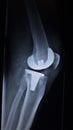 X-ray orthopedics scan of knee meniscus implant prosthetics