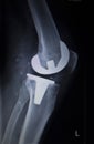 X-ray orthopedics scan of knee meniscus implant prosthetics