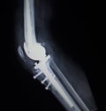 X-ray orthopedics scan of knee meniscus implant prosthetics