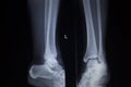 X-ray orthopedics scan of painful ankle foot injury Royalty Free Stock Photo