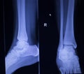 X-ray orthopedics scan of painful ankle foot injury Royalty Free Stock Photo