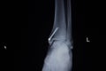 X-ray orthopedics scan of painful ankle foot injury Royalty Free Stock Photo