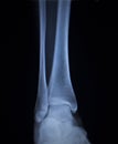 X-ray orthopedics scan of painful ankle foot injury Royalty Free Stock Photo