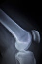 X-ray orthopedics scan of painful knee meniscus leg injury