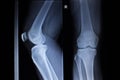 X-ray orthopedics scan of painful knee meniscus leg injury