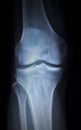 X-ray orthopedics scan of painful knee meniscus leg injury