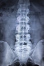 X-ray orthopedics Traumatology scan back pain spine injury Royalty Free Stock Photo