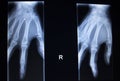 X-ray orthopedics Traumatology scan of hand finger injury Royalty Free Stock Photo